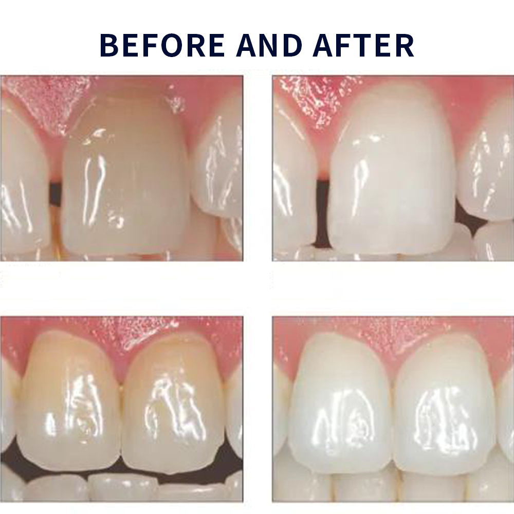 Opalescence Whitening 20% PF 2 - Teeth Whitening Bleaching Kit review and price