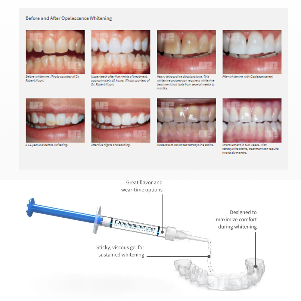 Opalescence Whitening 20% PF 2 - Teeth Whitening Bleaching Kit review and price