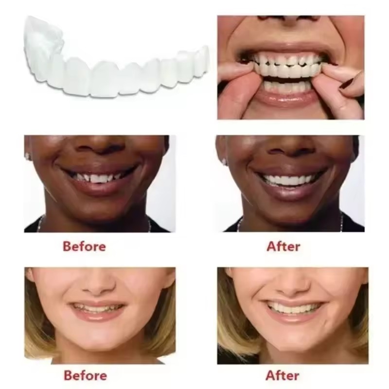 Teeth Veneers Whitening Dentur - Teeth Whitening Kit review and price