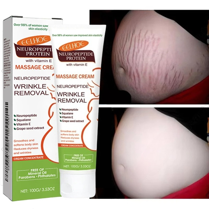 100g Stretch Marks Permanent R - Teeth Whitening Pregnancy review and price