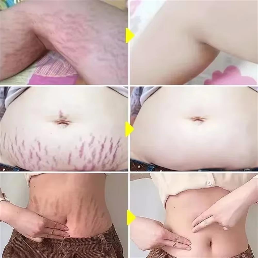 100g Stretch Marks Permanent R - Teeth Whitening Pregnancy review and price