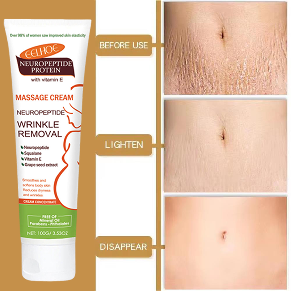 100g Stretch Marks Permanent R - Teeth Whitening Pregnancy review and price